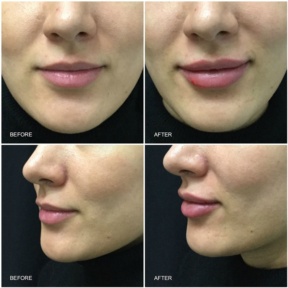 Lip Augmentation Before Treatment before and after treatments