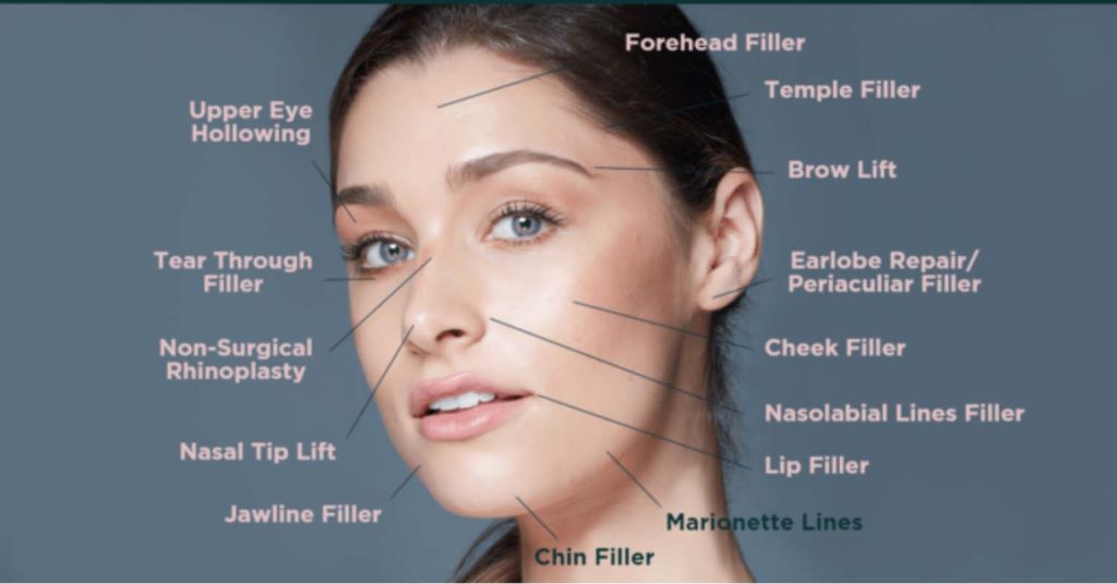 where to inject dermal filler